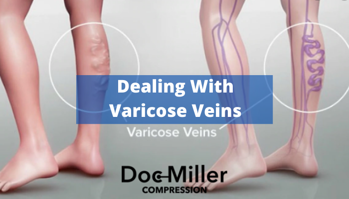Dealing with Varicose Veins - Calf Compression Sleeve for Varicose Veins